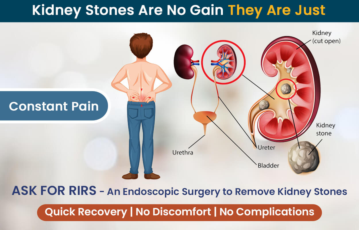 Kidney-stone