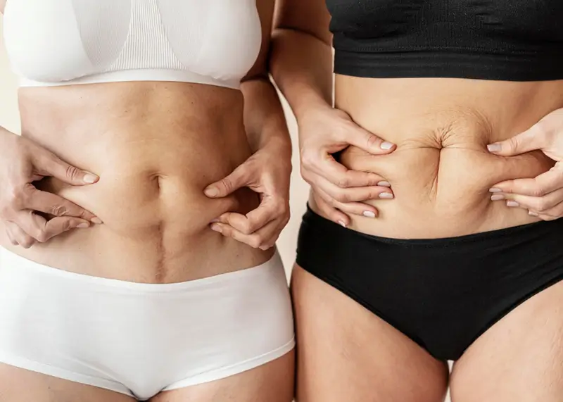 Tummy Tuck - Plastic Surgery